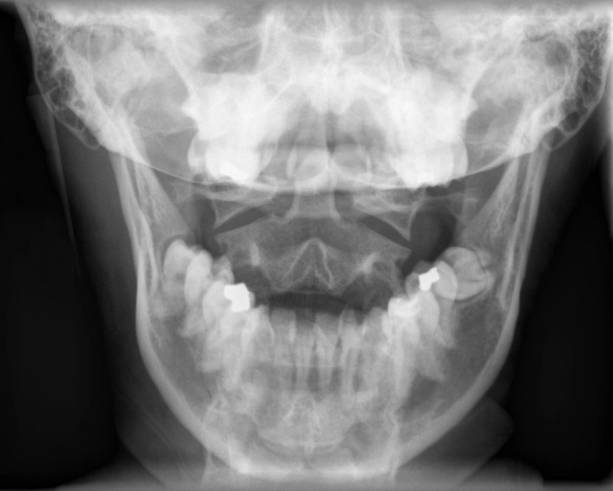 Dental Radiographs (XRays) Anchorage Pediatric Dentistry